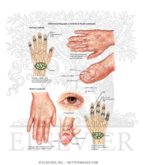 Differential Diagnosis of Arthritis In Hand