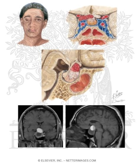 Pituitary Apoplexy