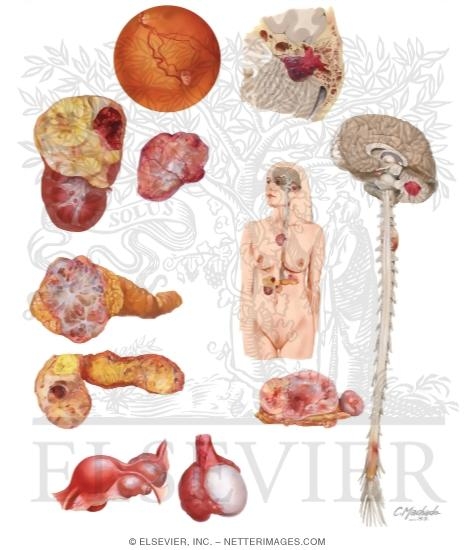 Von Hippel-Lindau Syndrome