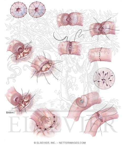 Azoospermia III: Reproductive Microsurgery