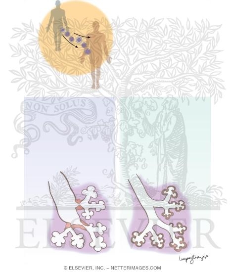 idiopathic pneumonia syndrome meddic