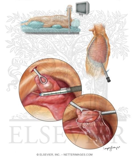 Video Assisted Thoracoscopic Surgery (VATS)