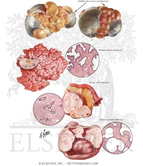 Epithelial Stromal Ovarian Tumors