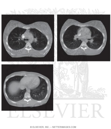 Chest Scans: Axial CT Images
