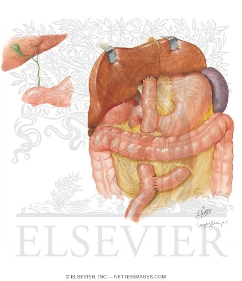 Biliary Atresia