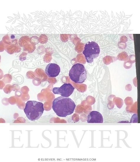 Clinical Presentation of Leukemia: Acute Myeloid Leukemia