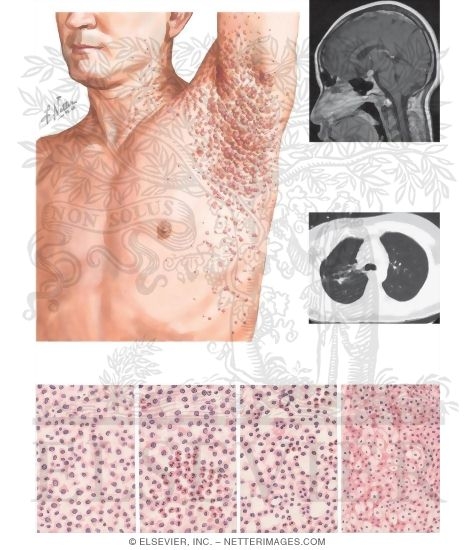 Medication for chickenpox in adults