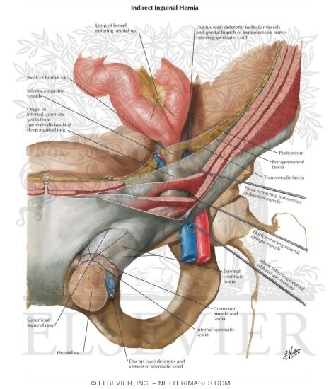 Coverings of Complete Indirect Inguinal Hernia
Hernia I - Indirect and Direct Inguinal Hernias
Indirect Inguinal Hernia