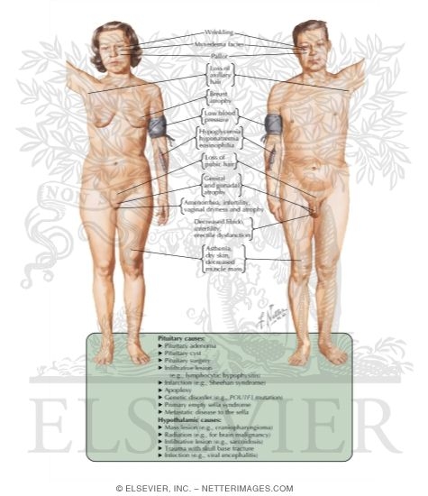 Pituitary Anterior Lobe Deficiency in Adults																																																																																																																																																																																																																																																				