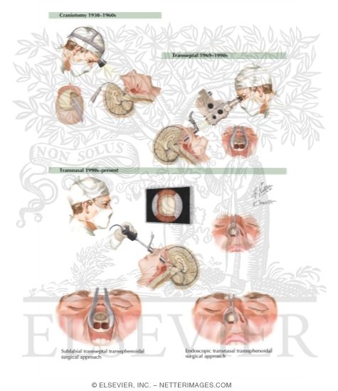 Surgical Approaches to the Pituitary																																																																																																																																																																																																																																																				