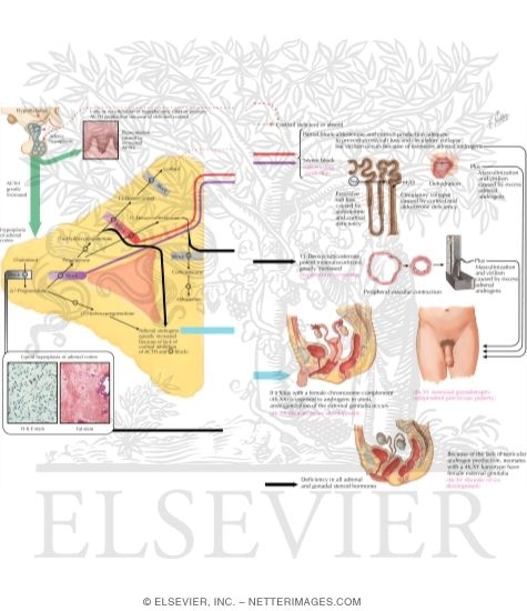 Classic Congenital Adrenal Hyperplasia