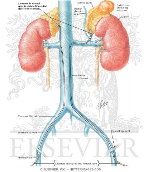 Adrenal Venous Sampling for Primary Aldosteronism																																																																																																																																																																																																																																																				