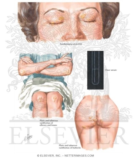 Hypercholesterolemic Xanthomatosis