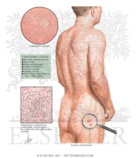 Hypertriglyceridemia
