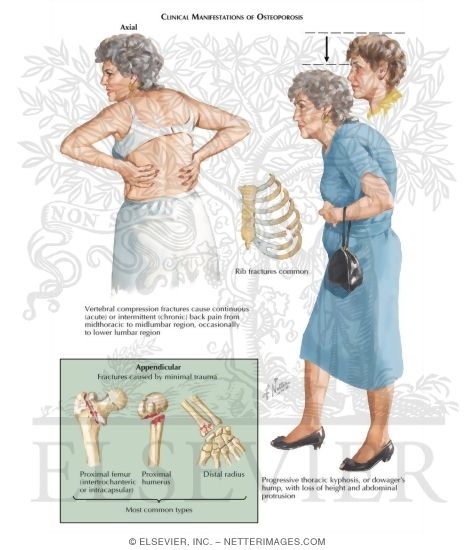 Clinical Manifestations of Osteoporosis