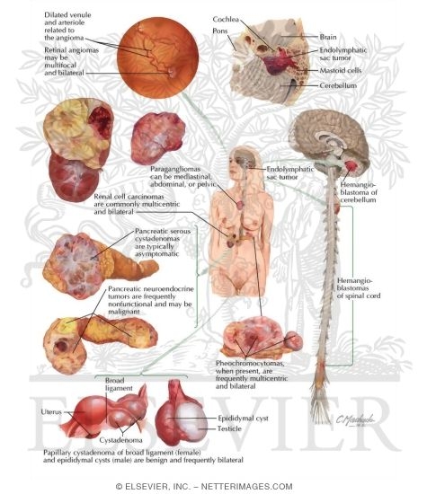 Von Hippel-Lindau Syndrome