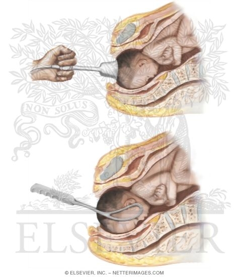 Operative Vaginal Delivery