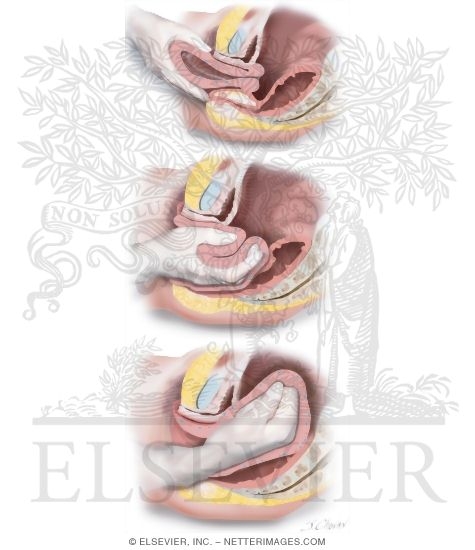 Uterine Inversion