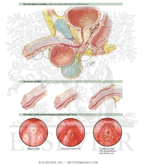 Urethral Anomalies, Verumontanum Disorders