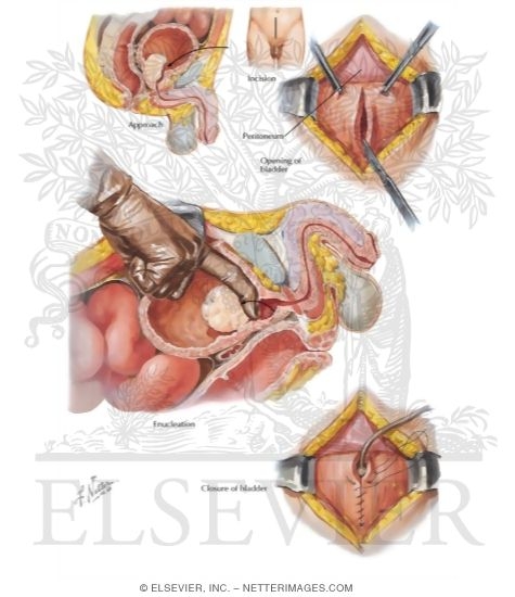 Benign Prostate Surgery I: Suprapubic