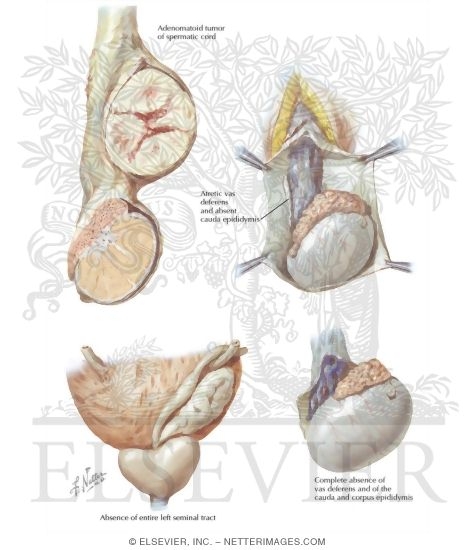 Anomalies of the Spermatic Cord