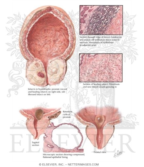 Prostatic Infarct and Cysts