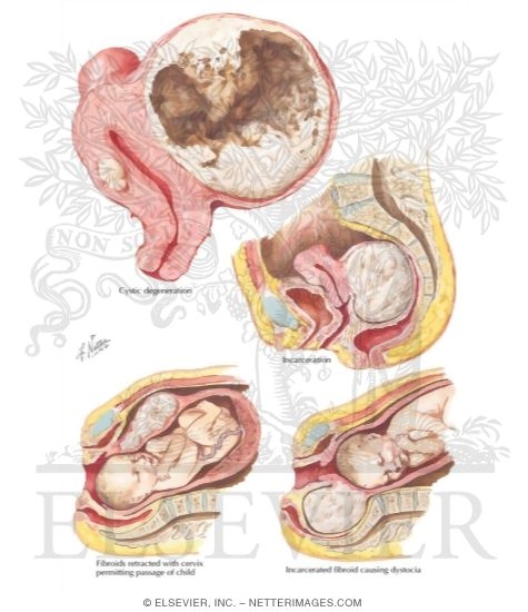 Myoma (Fibroid) III: Degeneration, Obstruction - Netter Medical ...