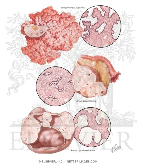 Papilloma, Serous Adenofibroma and Cystadenofibroma