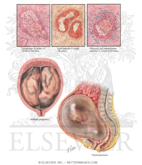 Causes of Decreased Maternal Circulation