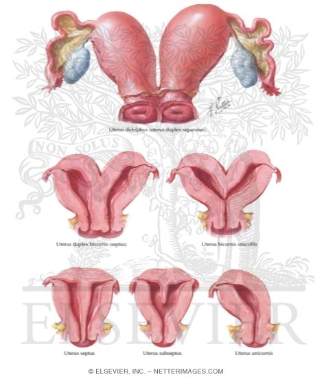 Uterine Anomalies: Bicornuate, Septate, and Unicornuate Uterus