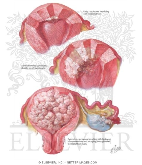 Cancer of Corpus I: Various Stages and Types