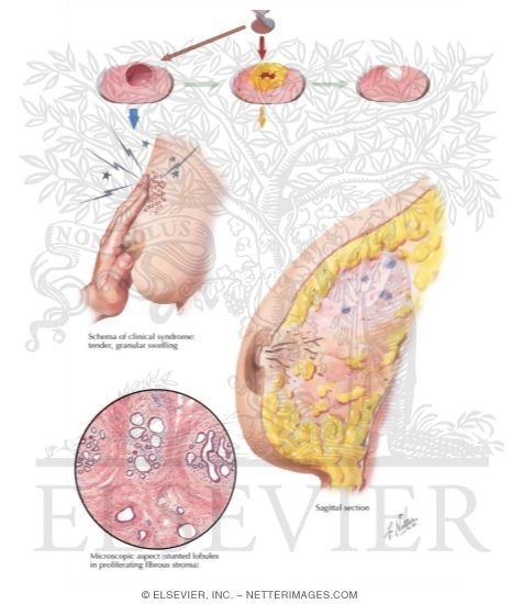 Fibrocystic Change I: Mastodynia