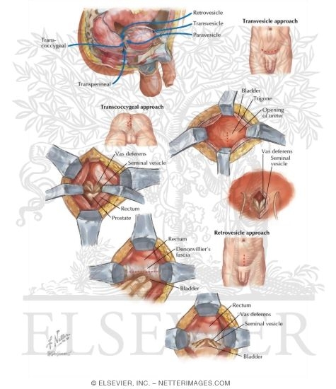 Seminal Vesicle Surgical Approaches