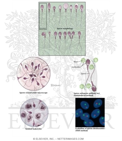 Semen Analysis and Sperm Morphology