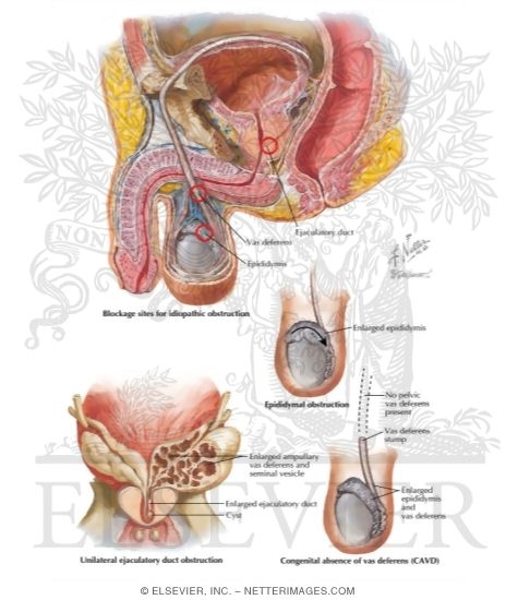 Azoospermia II: Excurrent Duct Obstruction