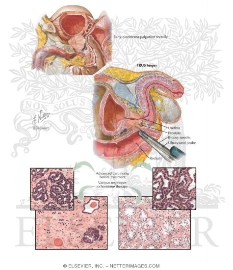 Carcinoma of Prostate III: Diagnosis, Treatment, Palliation