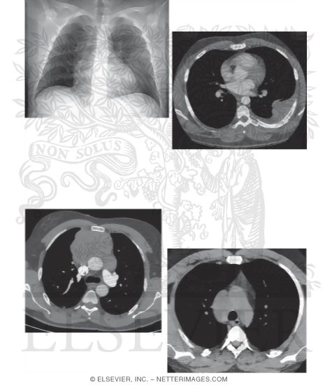 Radiologic Examination of the Lungs