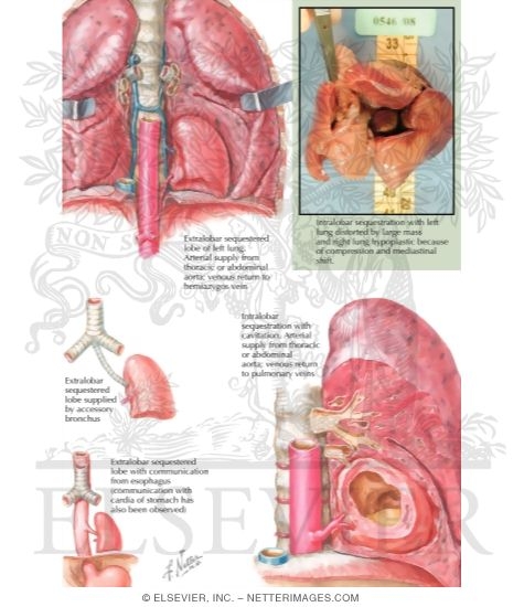 Pulmonary Sequestration