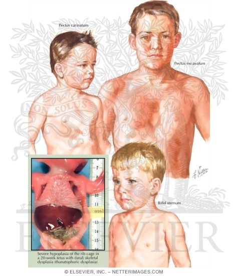 Congenital Deformities of the Thoracic Cage