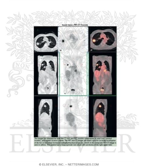 Images from a PET-CT Scanner
