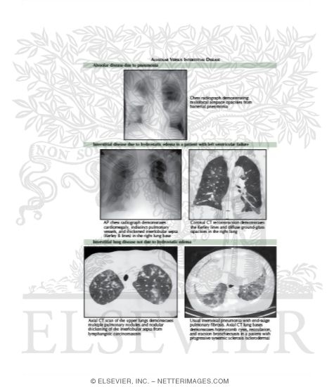 Alveolar Versus Interstitial Disease