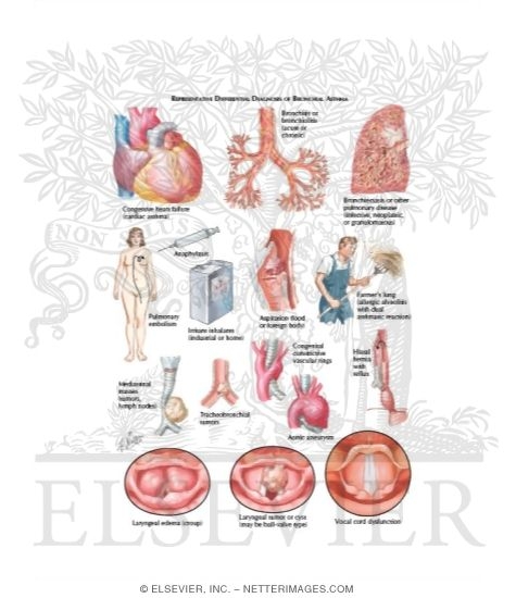 Bronchial Asthma