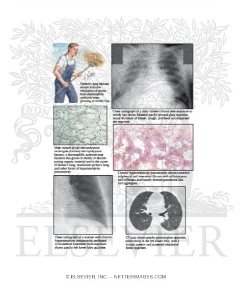 Hypersensitivity Pneumonitis