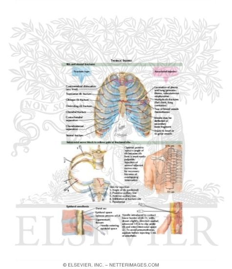 Rib and Sternal Fractures