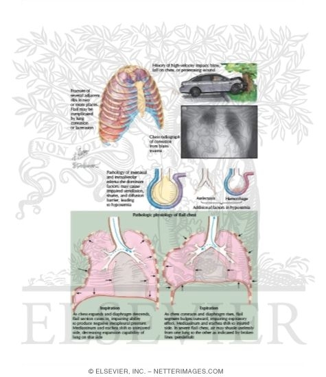 Flail Chest and Pulmonary Contusion