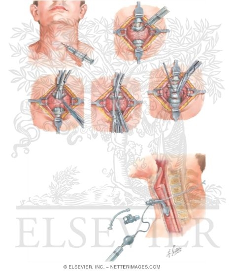 Tracheostomy