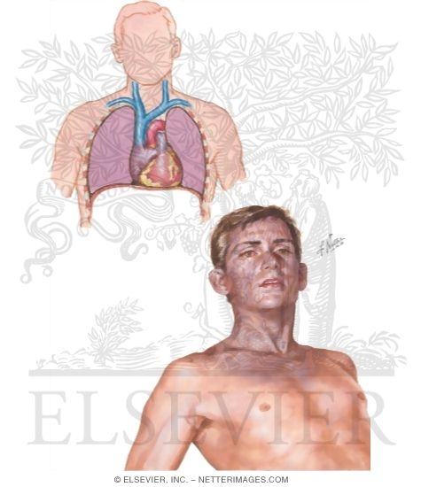 Traumatic Asphyxia