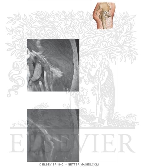 Cross Section of the Hip: Coronal View
