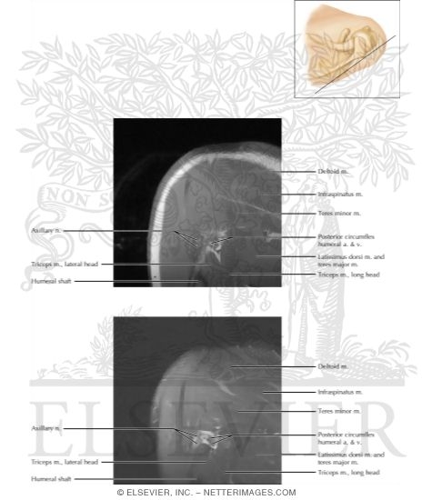 Shoulder Coronal 1
