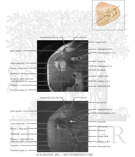 Shoulder Coronal 9